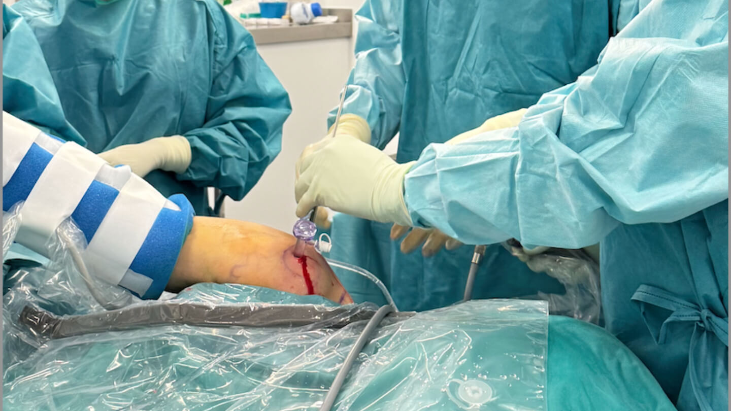 protesis-reversa-hombro-fracturas-complejas-humero