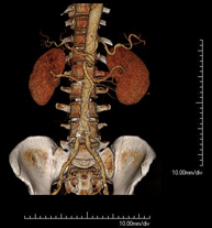 Angio-TC aorta abdominal_1