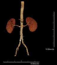 Angio-TC aorta abdominal_2
