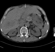 Biopsia abdominal guiada por TC