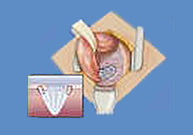 Hernioplastia según la técnica de rutkow-Robbins_2