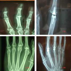 Artrosis de los dedos y tratamiento quirúrgico