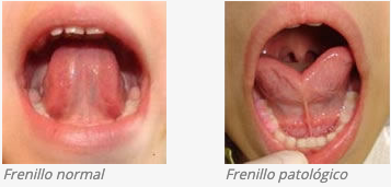 Frenillo labial corto