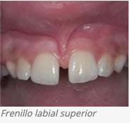 frenillo labial superior