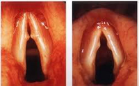 Nódulos en las cuerdas vocales
