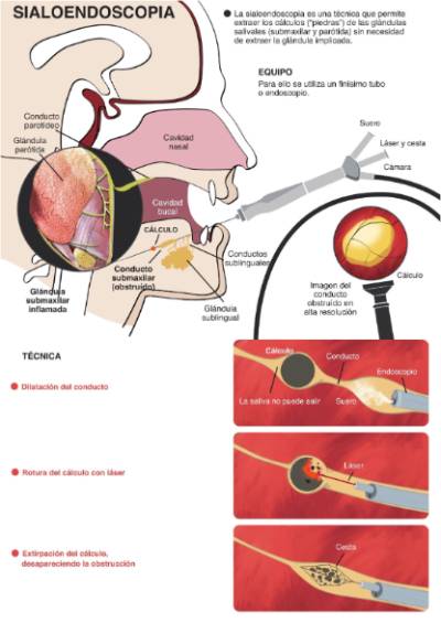 Sialoendoscopia_A4-1