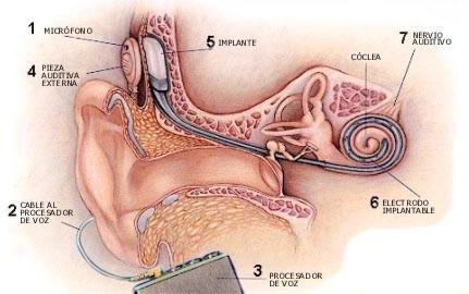 implante coclear