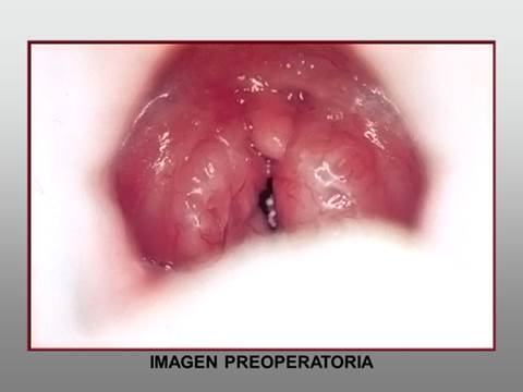 hipertrofia-image001