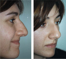 cirugia-estetica-nasal-1