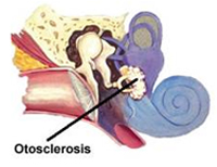 otosclerosis