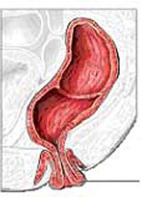 Prolapso rectal
