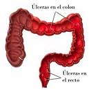 Colitis ulcerosa