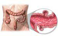 Diverticulosis