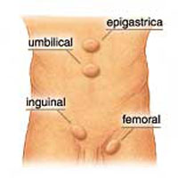 hernias