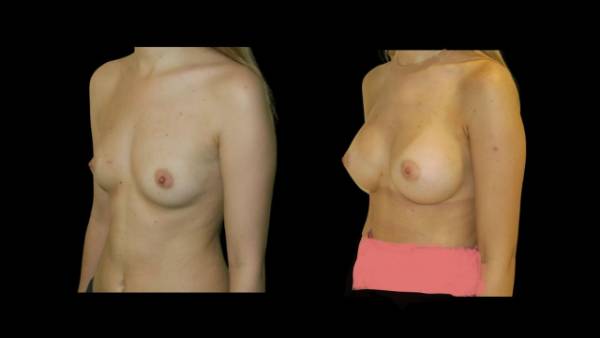 antes y después aumento de mama