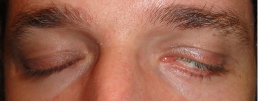 parálisis facial