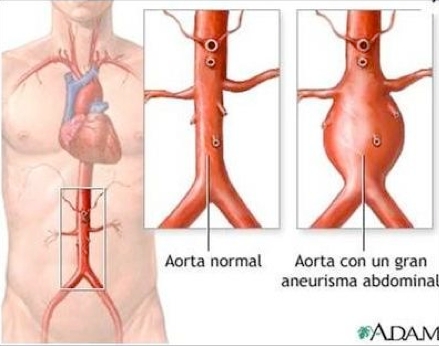 aorta abdominal