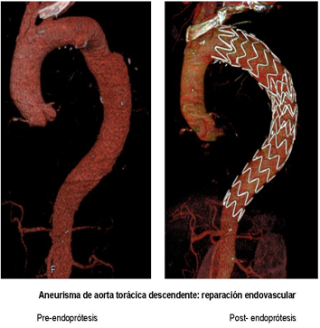aneurisma de aorta toracica descendente reparacion endovascular