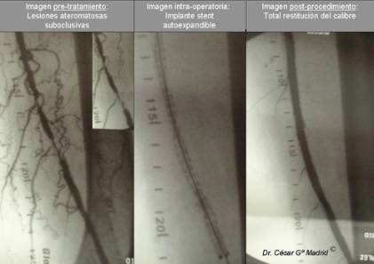 tratamiento by pass úlceras dr cesar garcia madrid