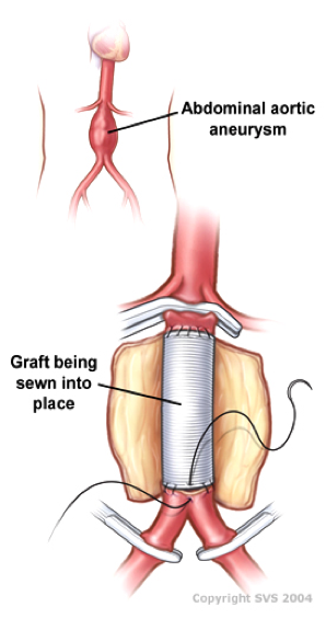 cirugia de la aorta abdominal by pass