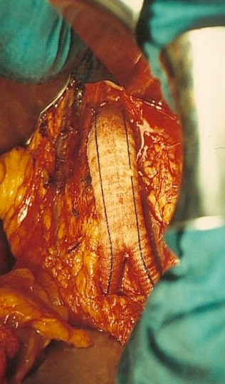 cirugia aorta by pass