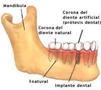 Implante_dental
