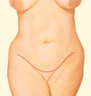Corte-abdominoplastia