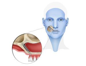implantes zigomaticos