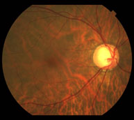 Glaucoma de ángulo abierto