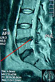 Imagen de una hernia discal, en que se observa cómo la rotura del anillo comprime la estructura nerviosa de la columna