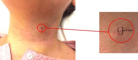 Imagen final postoperatoria de la herida quirúrgica en el cuello de la paciente de sólo 3 mm de longitud.