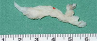 Gran fragmento de hernia discal lumbosacra extraída por vía endoscópica interlaminar