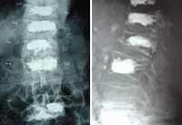 Cifoplastia_07