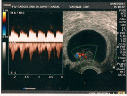 Ecografía-del-tratamiento-de-FIV-ICSI