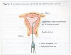 Esquema-de-procedimiento-de-Inseminación-Artificial