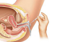 Biopsia endometrial