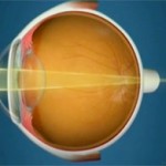Oftalnova-oftalmologia-barcelona-ojo-con.-astigmatismo-150x150