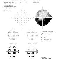 Campimetria-estudio-campo-visual-prueba-medica-oftalnova-barcelona-2-200x200
