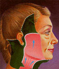 Separación del tejido de la cara y cuello de la musculatura