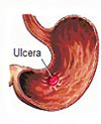 Úlcera de estómago