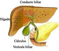 colelitiasis