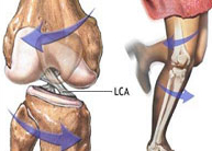 Lesiones ligamentosas de rodilla