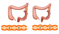 Divertículos de colon