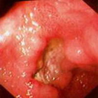 Úlcera gástrica