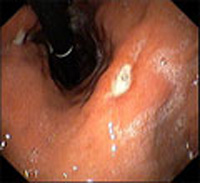 ulcera gastroduodenal_2