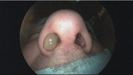 Poliposis Nasal foto