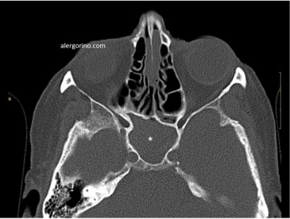 tomografía computarizada sinusitis crónica