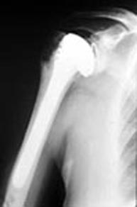 Radiografía de una prótesis total de hombro
