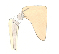 Figura 4. Prótesis invertida de hombro