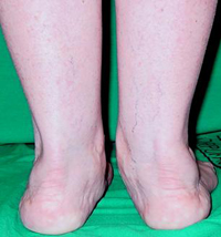 Deformidades estrcturales del pie